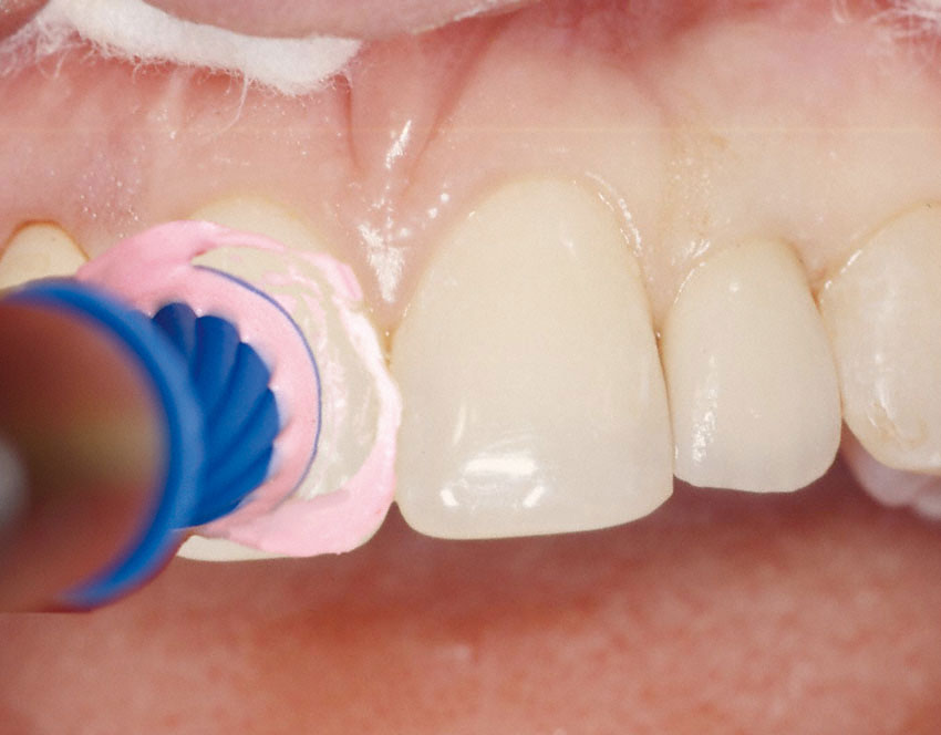 Professionelle Zahnreinigung mit speziellen Polierpasten